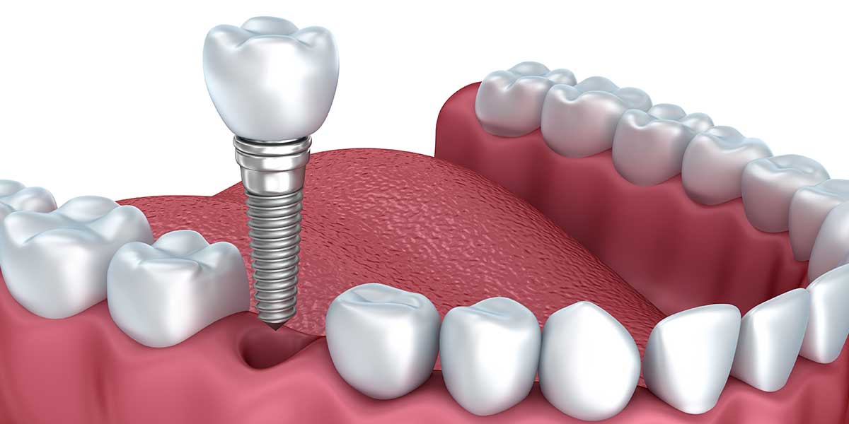 Single Dental Implant Graphic