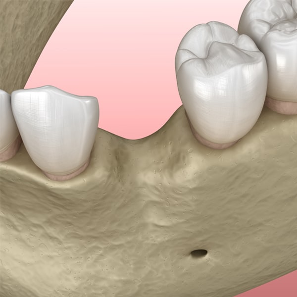 Bone Grafting Decorative Image