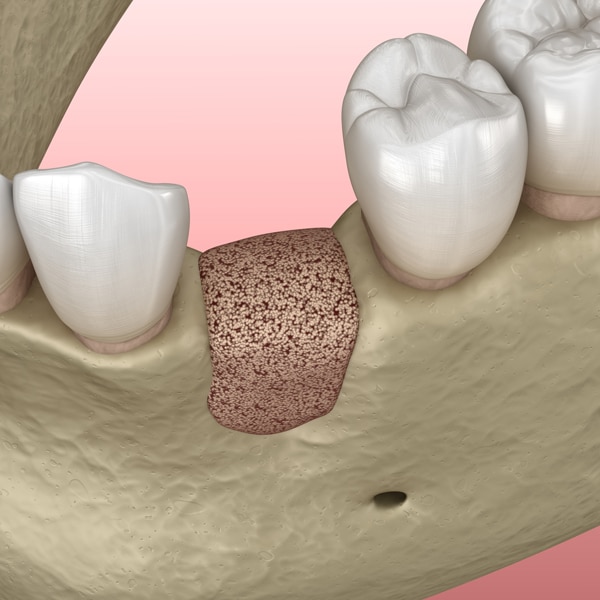 Bone Grafting Decorative Image