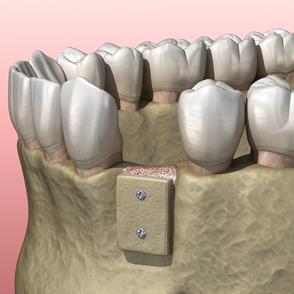 Bone Grafting Decorative Image