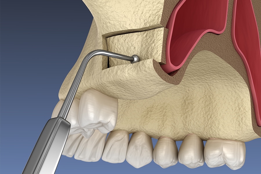 Bone Grafting Sinus Lift Image