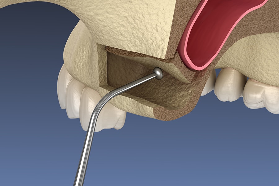 Bone Grafting Sinus Lift Image