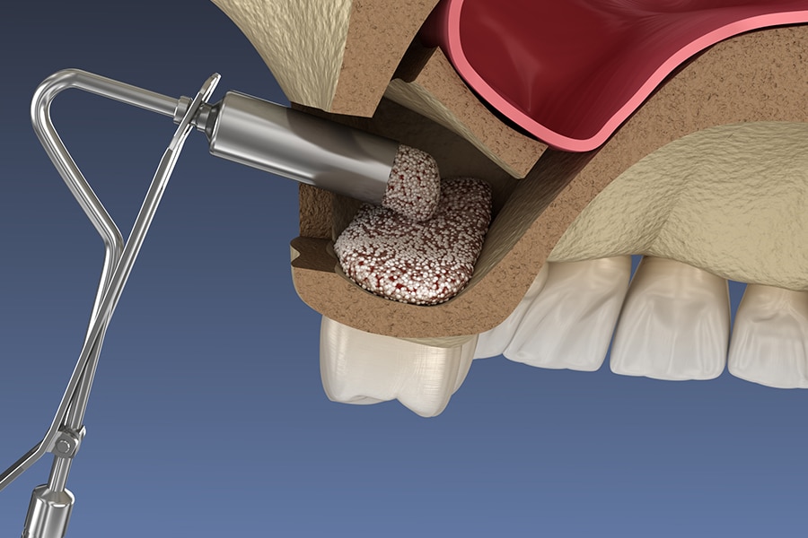 Bone Grafting Sinus Lift Image
