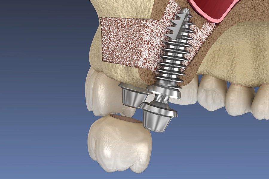 Bone Grafting Sinus Lift Image