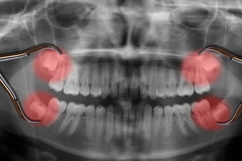 What Can I Eat After Wisdom Teeth Removal?