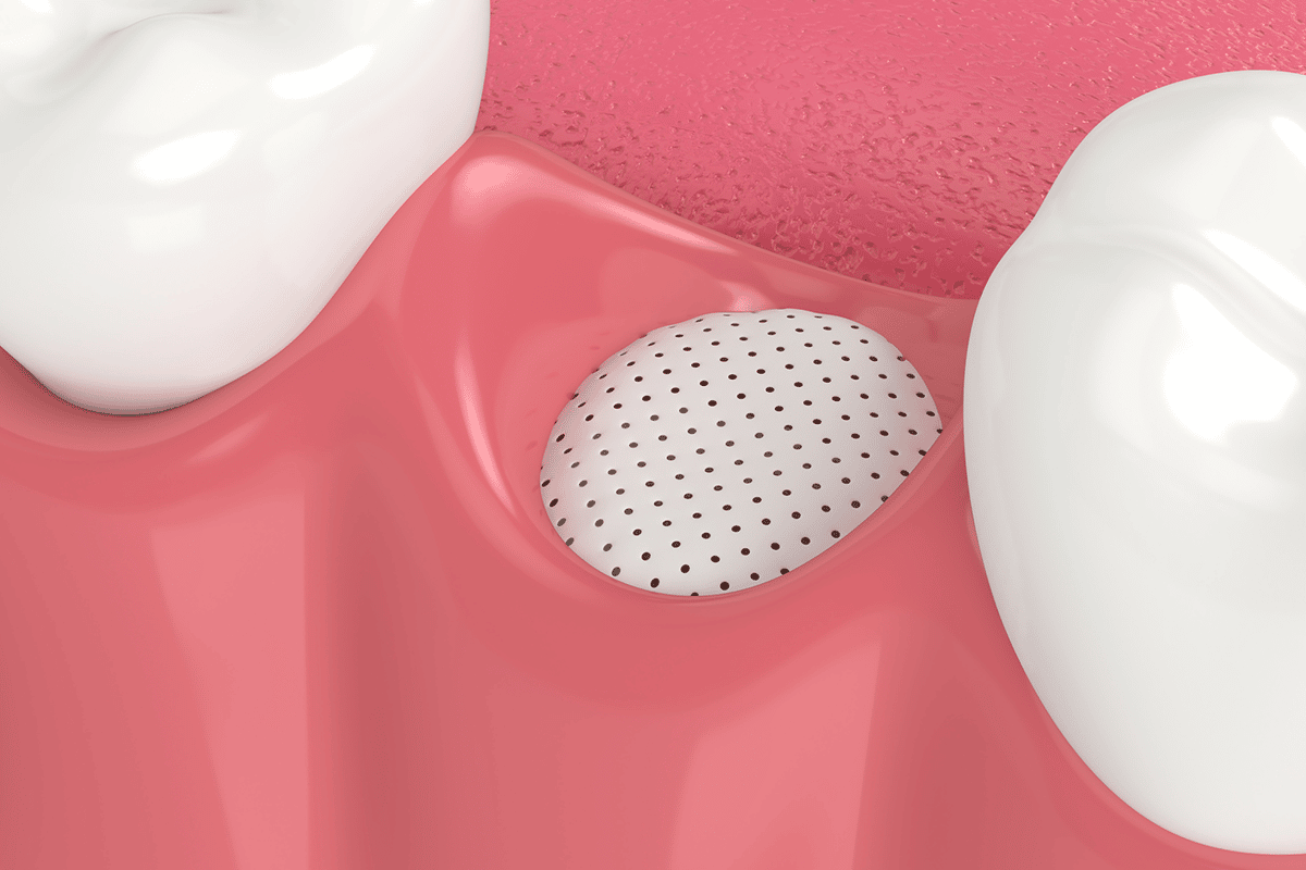 Cost of Bone Grafting in Manchester, NH Manchester Oral Surgery